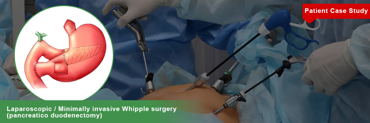 Laparoscopic Minimally Invasive Whipple Surgery Pancreatico