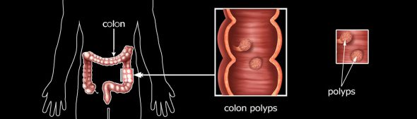 Colon Polyps – Understanding Colon Polyps and it’s Causes