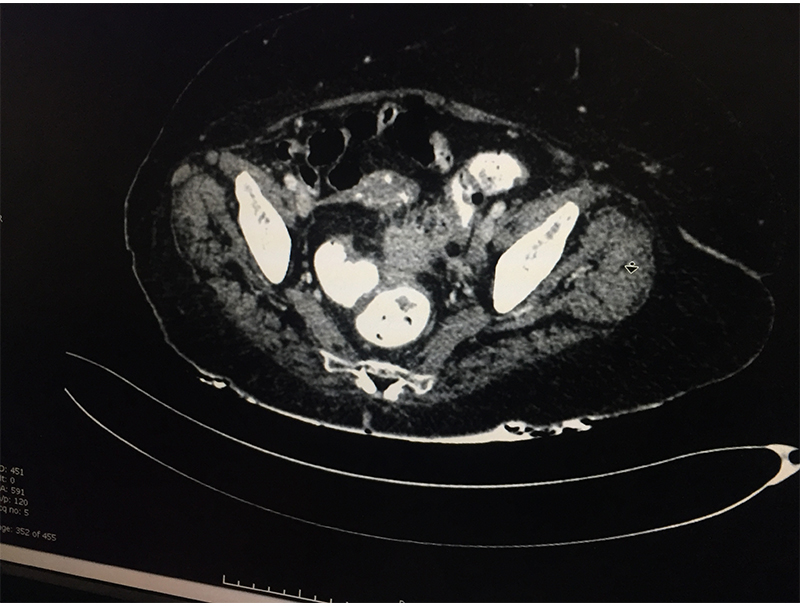 diverticular