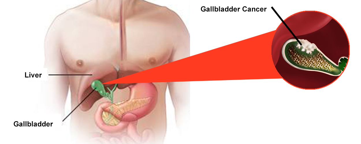 Gallbladder Cancer