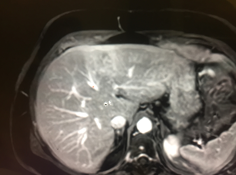 Intrahepatic cholangiocarcinoma