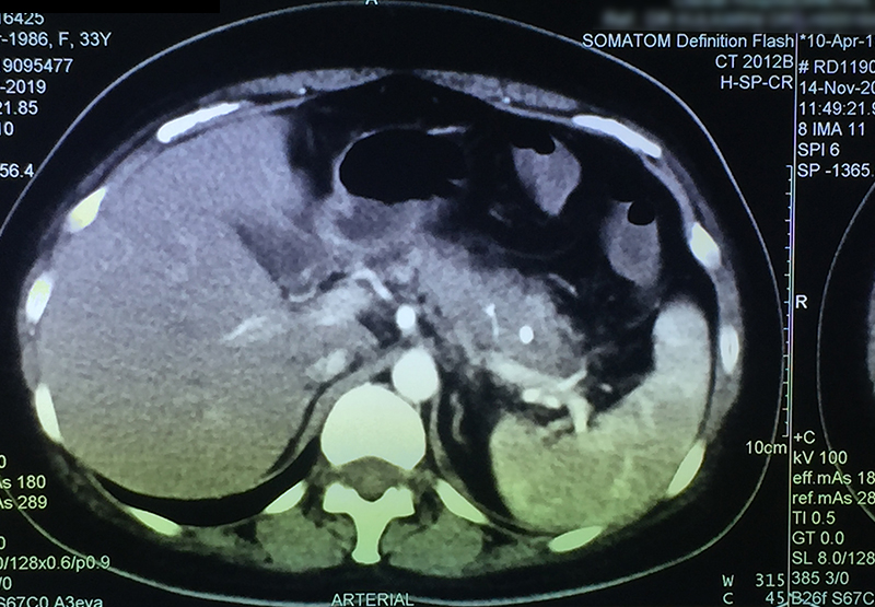 Pancreatic Duct Stenting