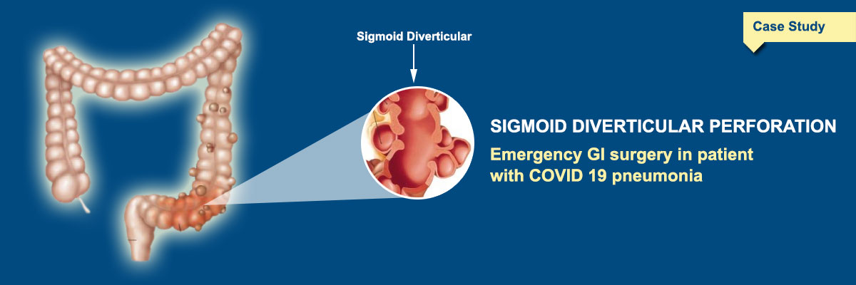 Sigmoid Colon Diverticula