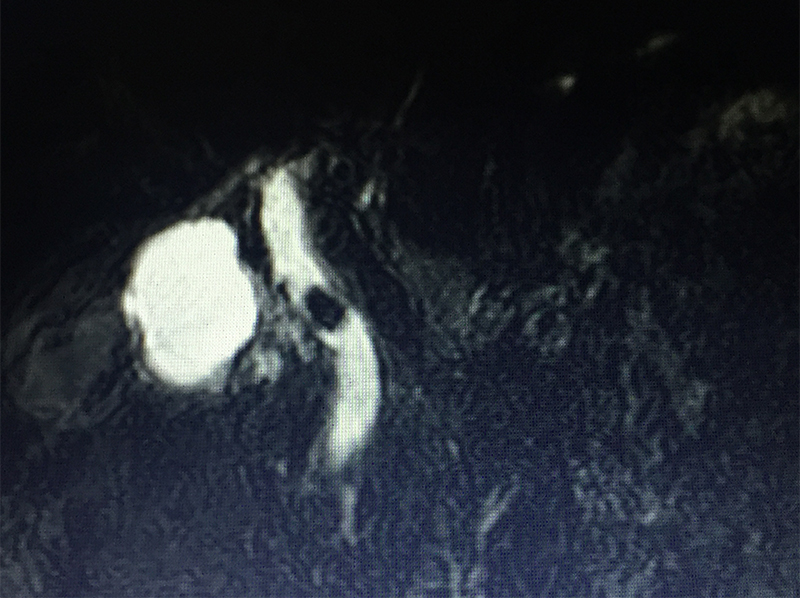 acute calculous cholecystitis