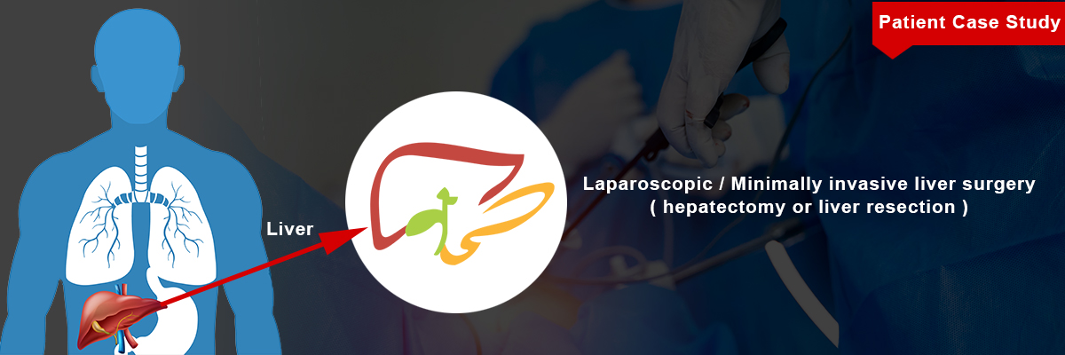 Hepatectomy or Liver Resection