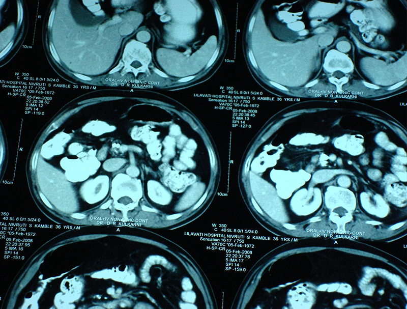 chronic calcific pancreatitis