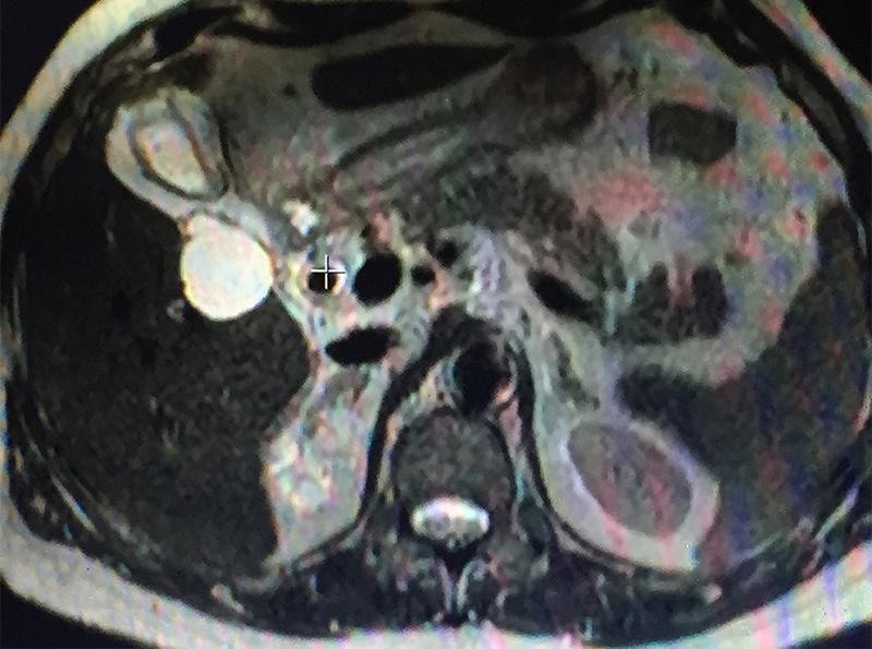 calculous cholecystitis