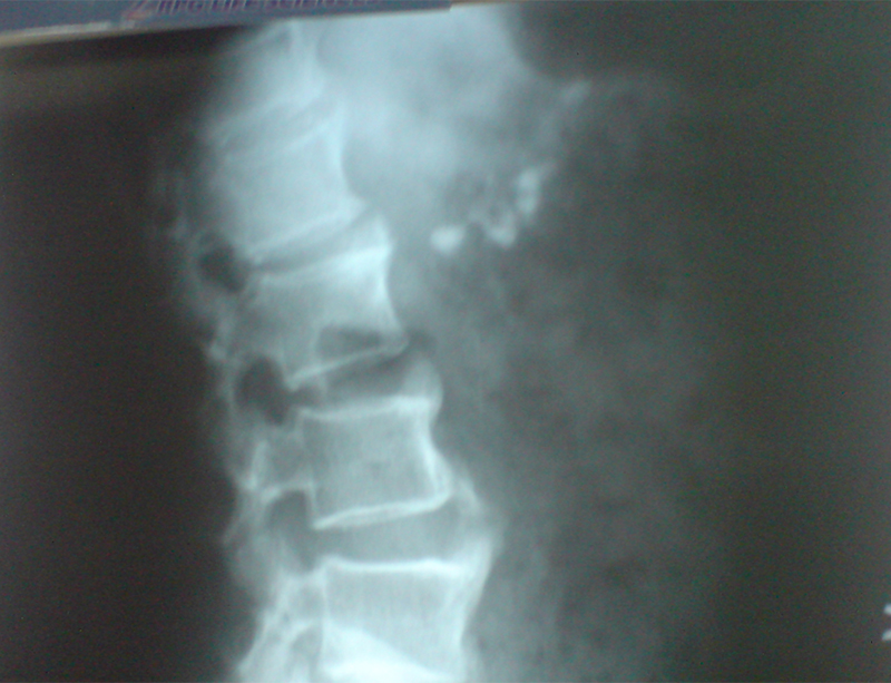 chronic calcific pancreatitis