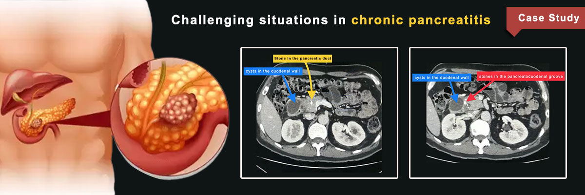 Chronic Pancreatitis