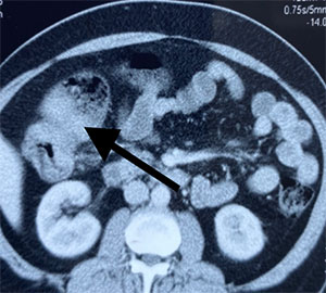 colonic cancer