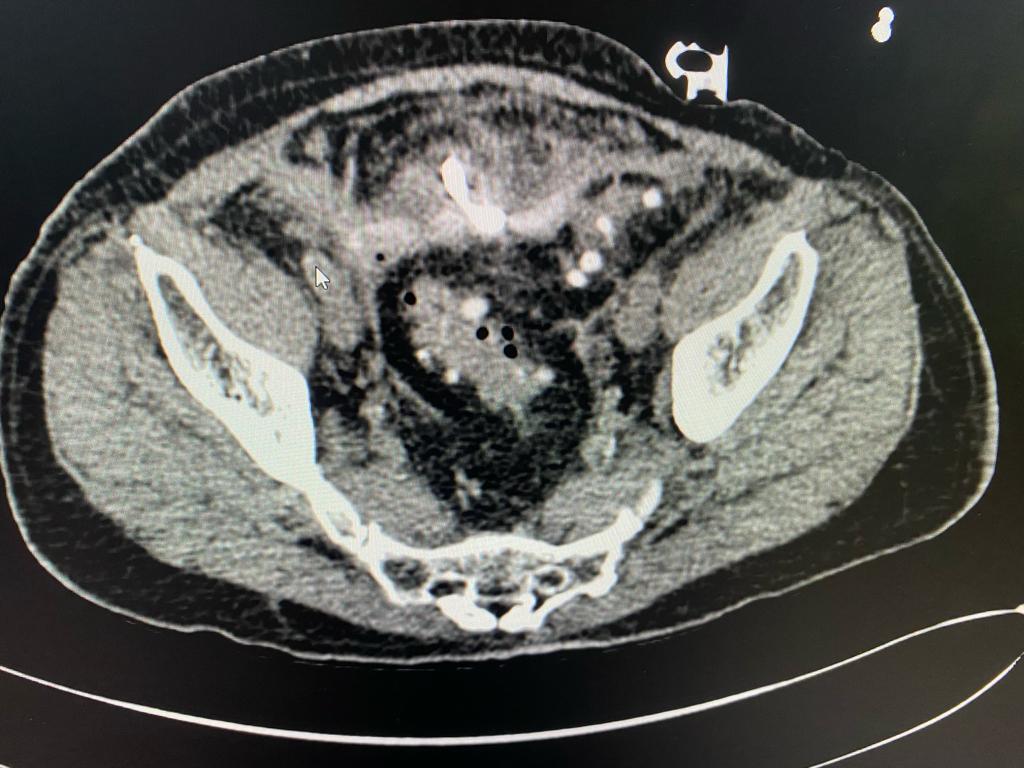 Diverticulitis - Challenging Situations in Colonic Diverticulitis: Case ...