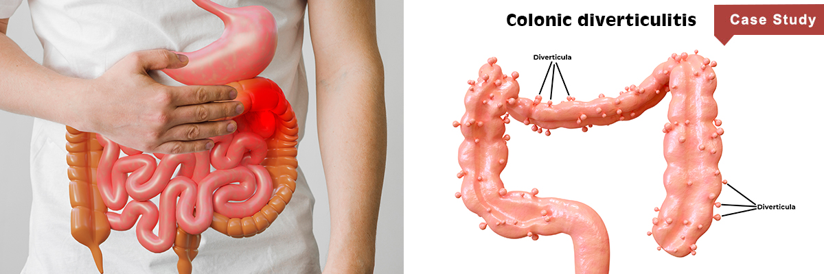 colonic diverticulitis