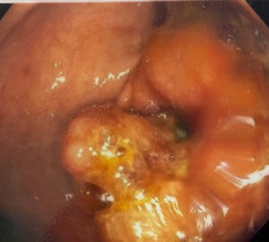 colonic tumor