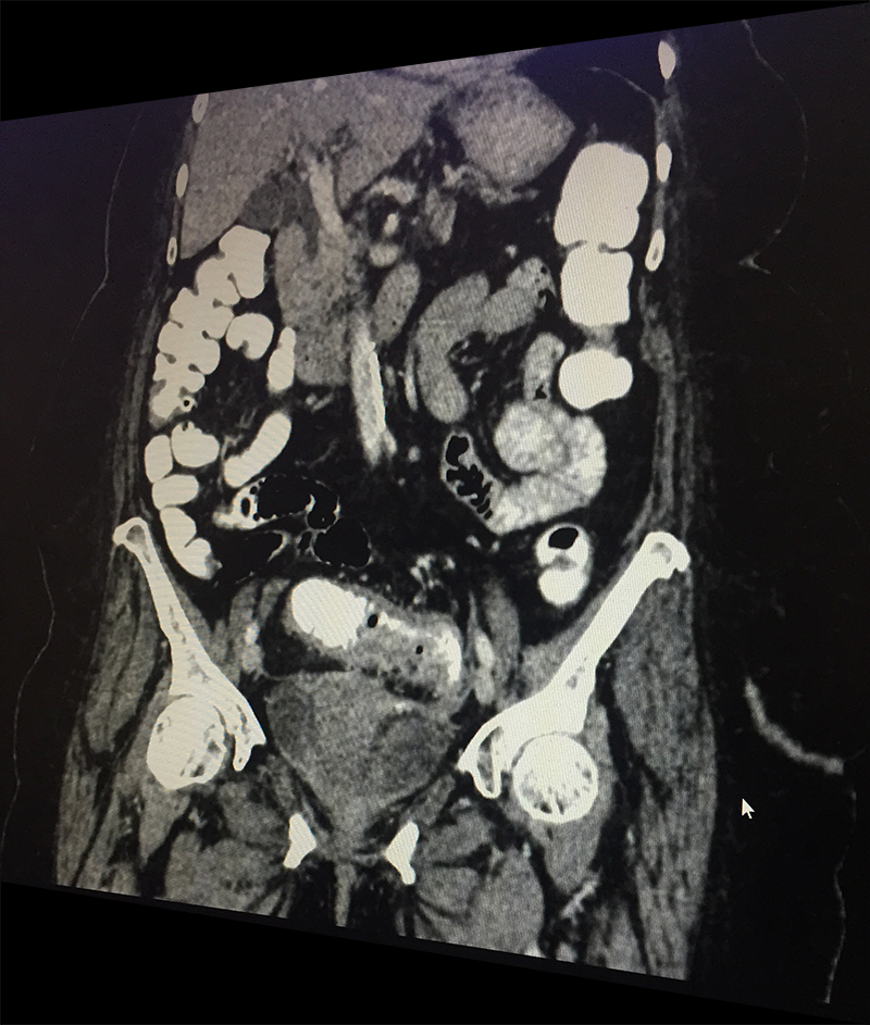 episode of sigmoid diverticular