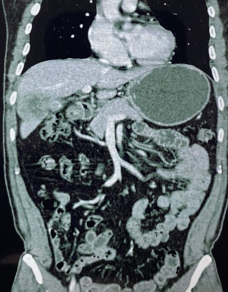 ca gallbladder