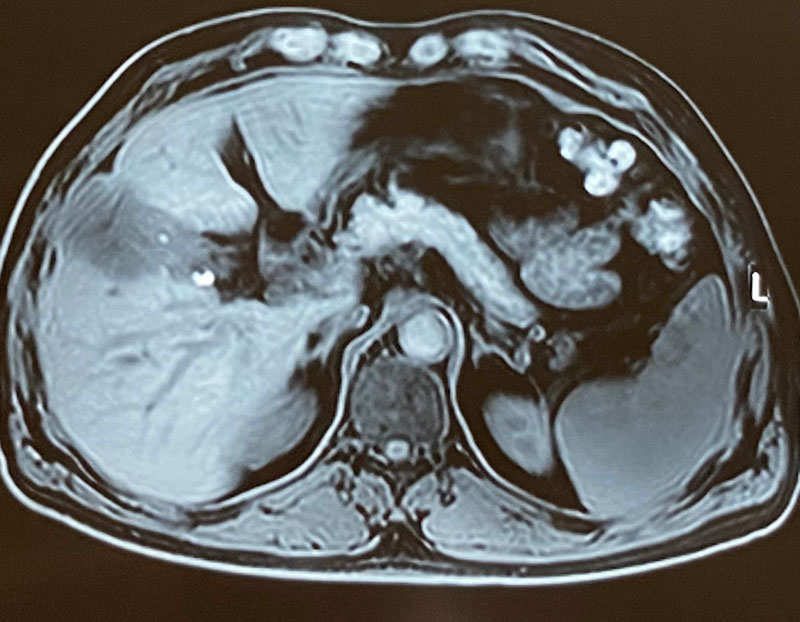 gall bladder