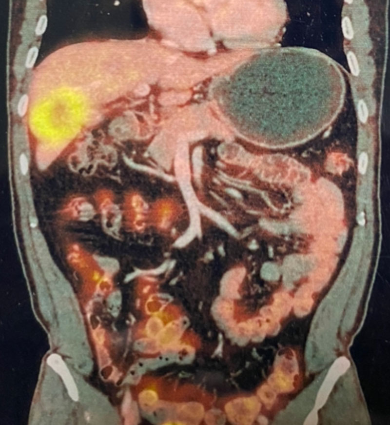 gallbladder tumor