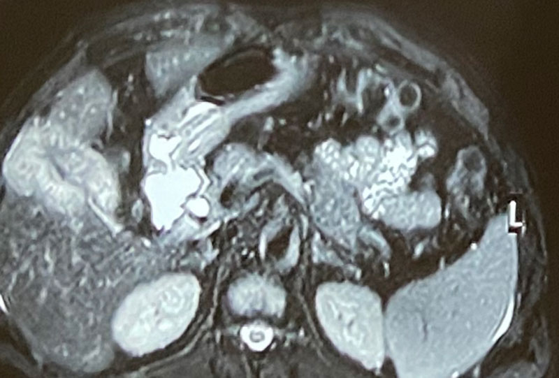 removal of gall bladder