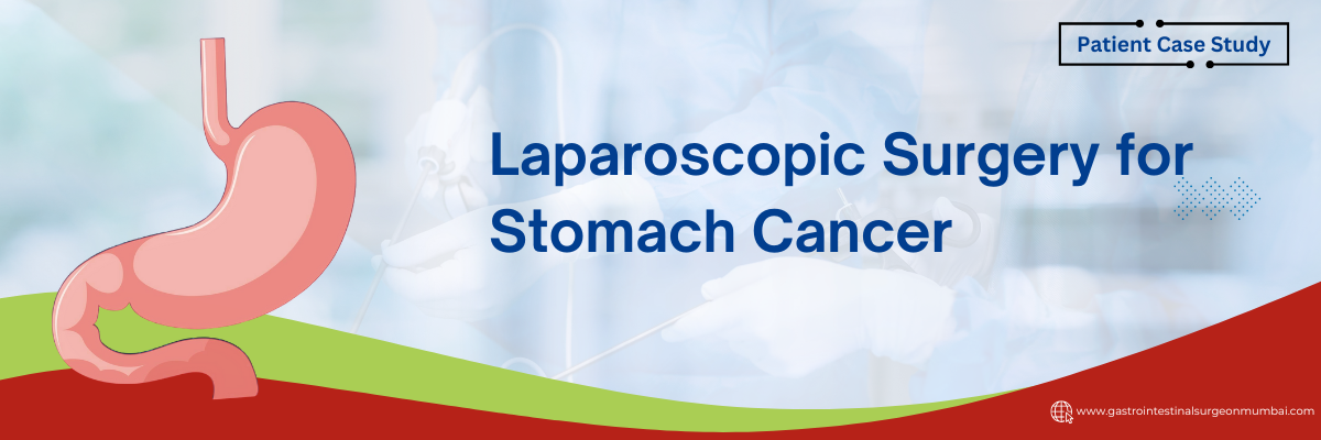 Laparoscopic Surgery for Stomach Cancer