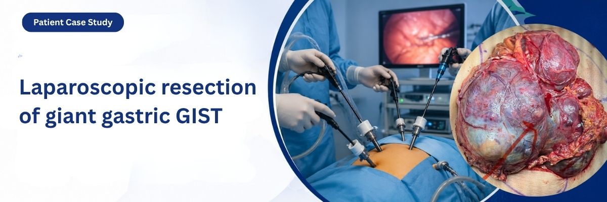 Laparoscopic resection of giant gastric GIST