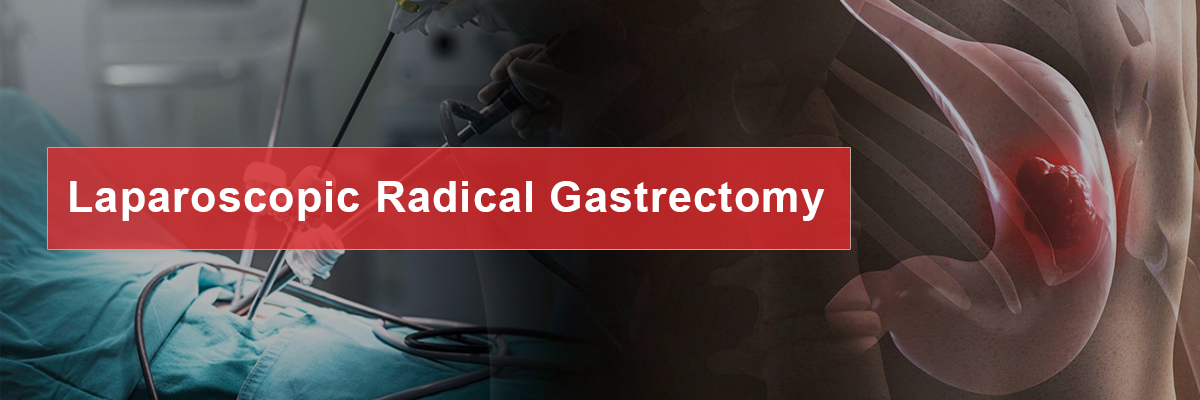 Laparoscopic Radical Gastrectomy