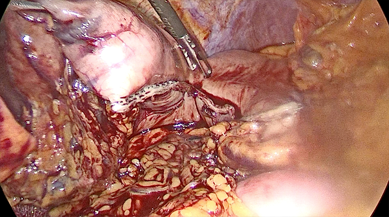 laparoscopic surgery for peptic ulcer