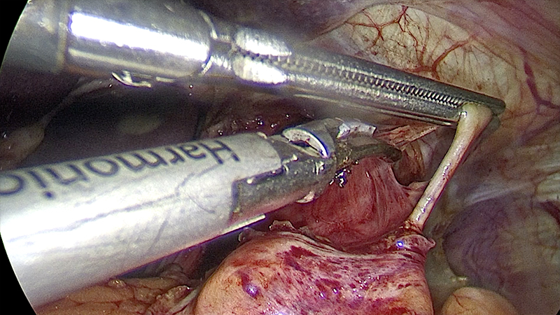 laparoscopic surgery of peptic ulcer