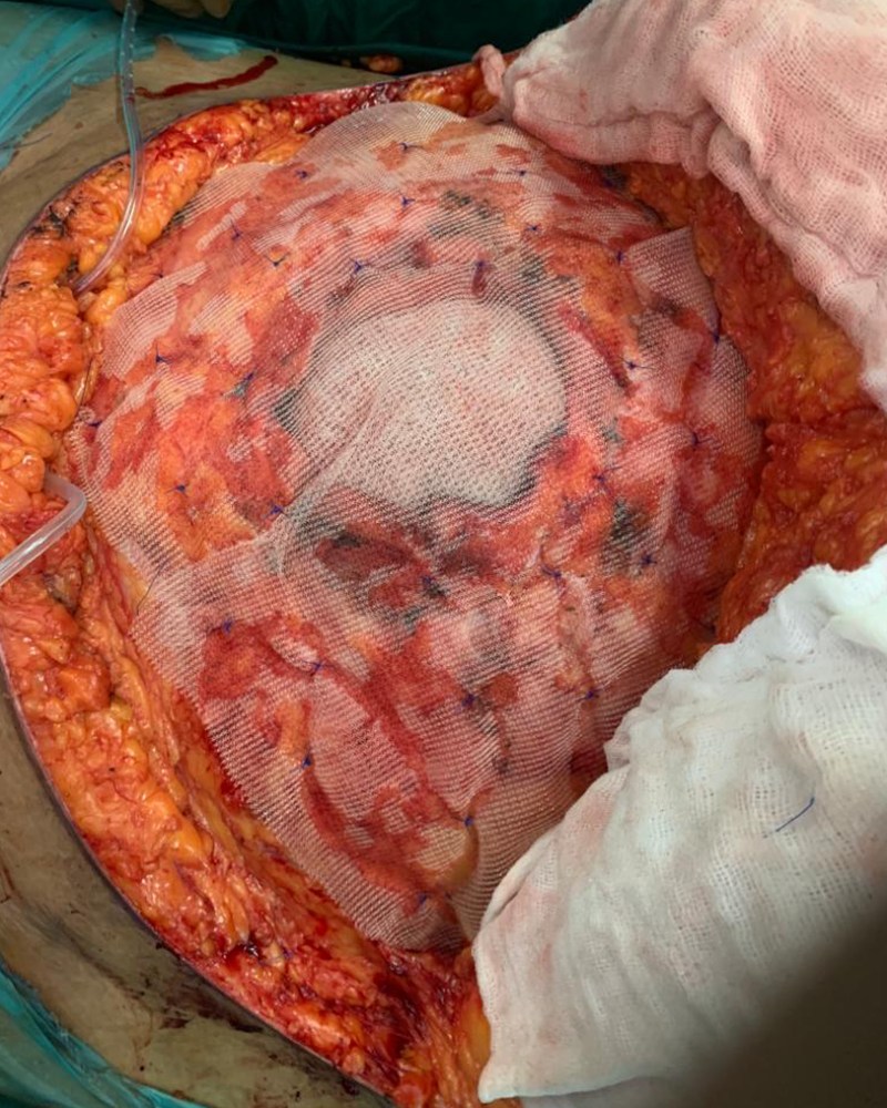 large abdominal hernia repair