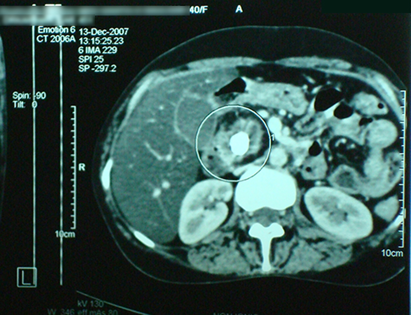 pancreatic duct