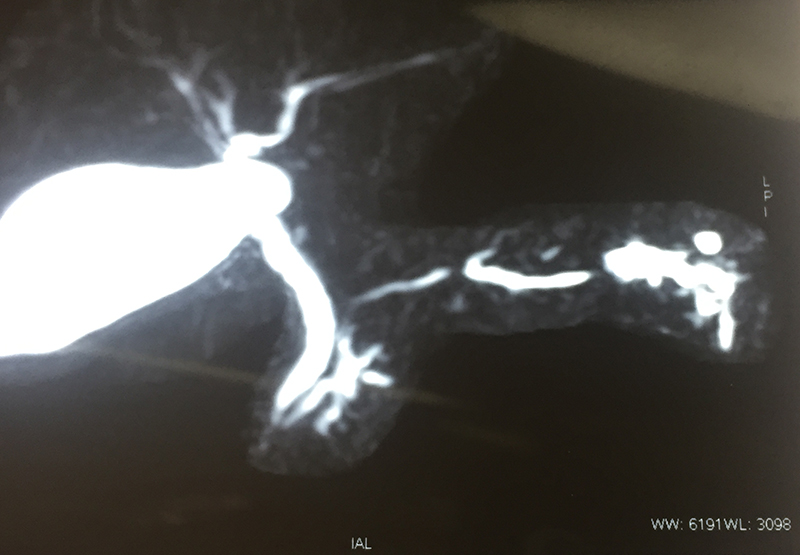 pancreatic stent complications