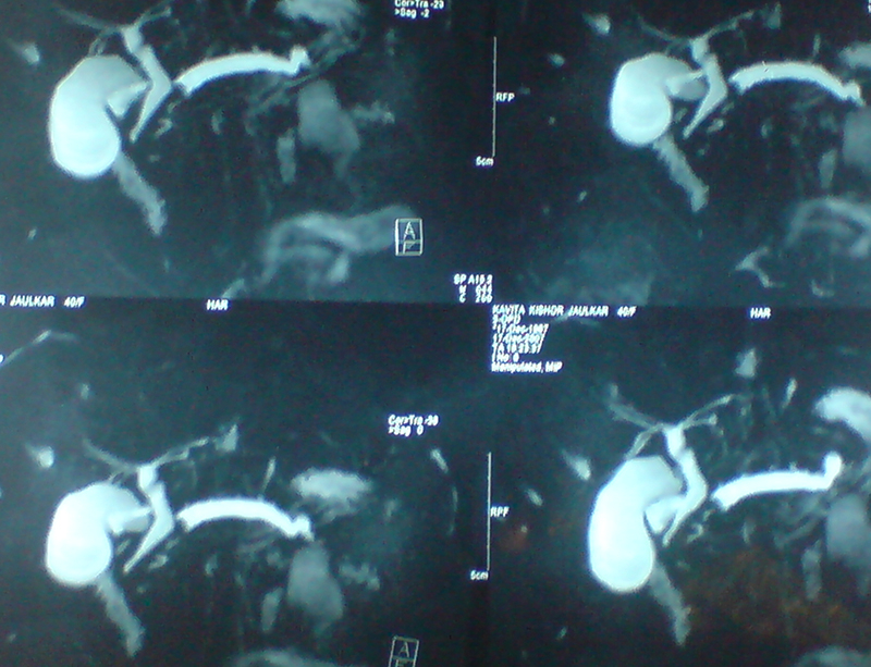 pancreatic stones