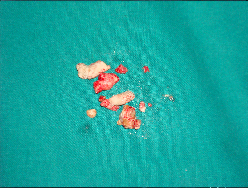 pancreatitis stone