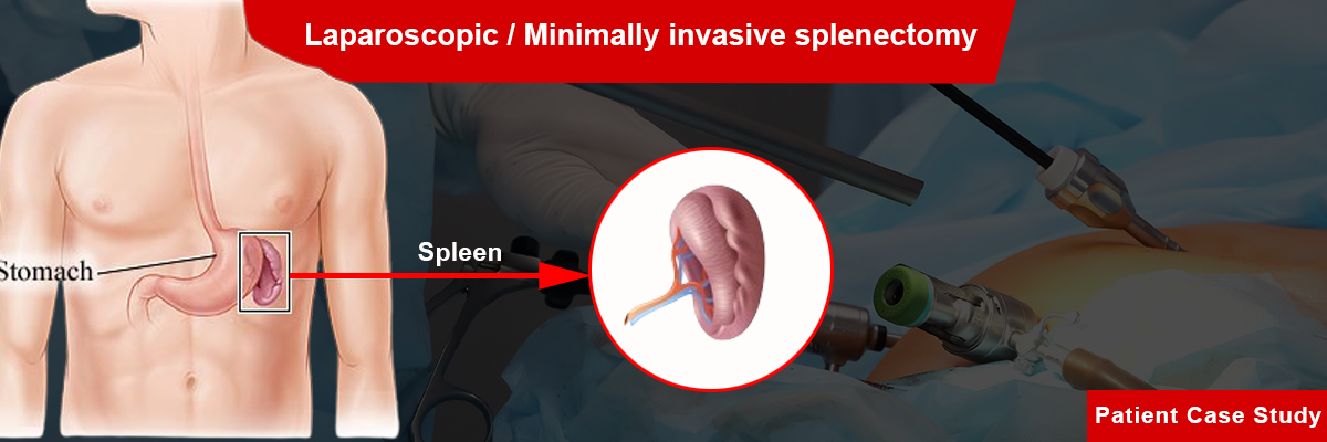 Splenectomy