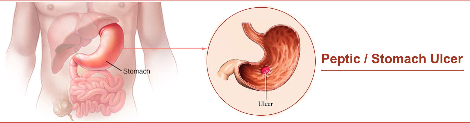 Peptic / Stomach Ulcer