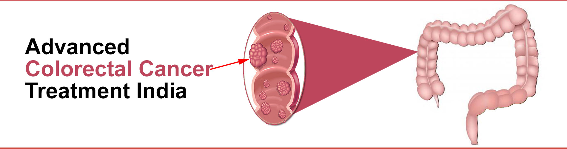 colon and rectal cancer